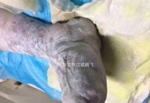 玉树严重冻伤的处理方法（从急救到康复，关键在于及时有效的处理）